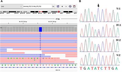 Homozygous deep intronic variant in SNX14 cause autosomal recessive Spinocerebellar ataxia 20: a case report